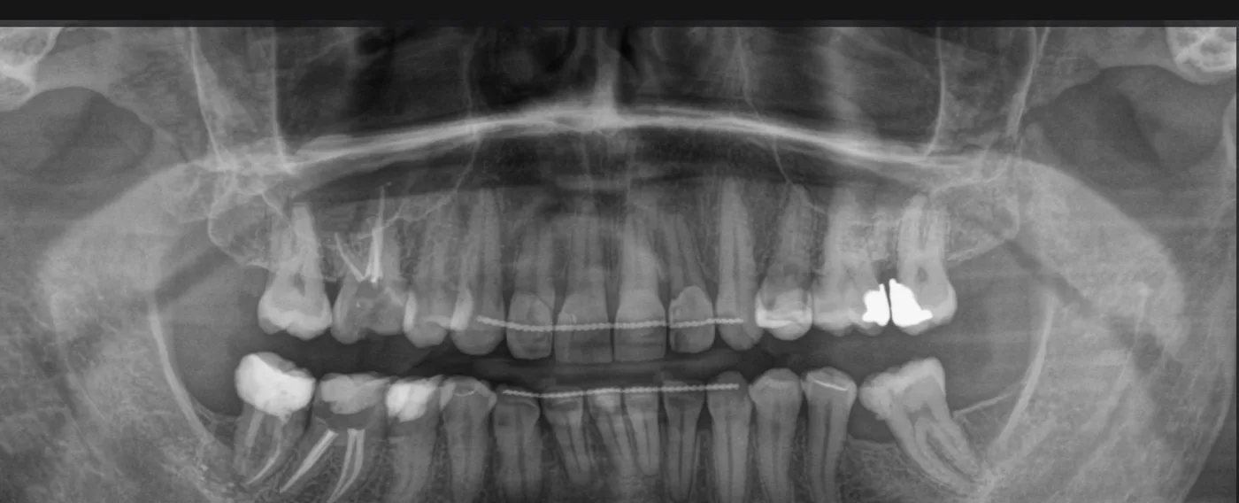 Pantomogram diagnostyczny — pełna ocena układu zębowego pacjenta bólowego
